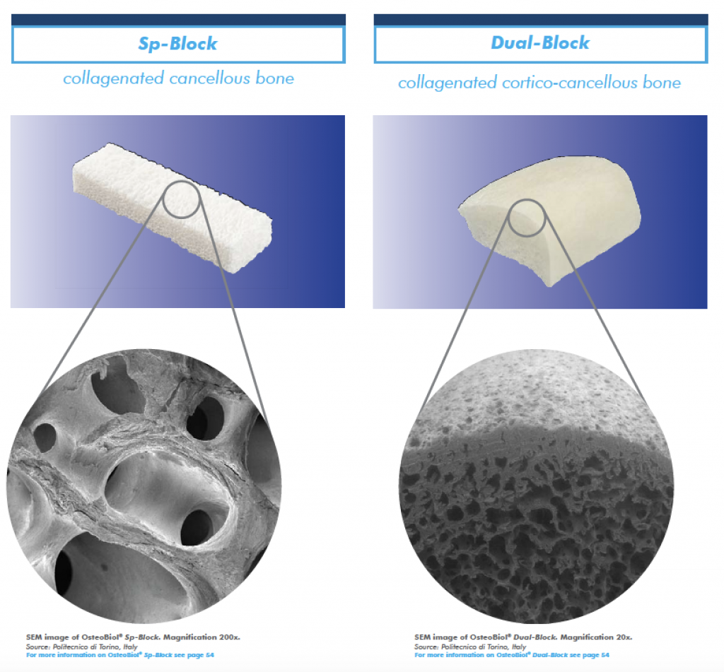 Osteobiol Sp-Block Dual-Block