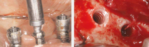 Implantaat extractie systeem