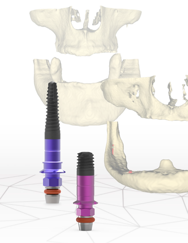 BTI implantaten